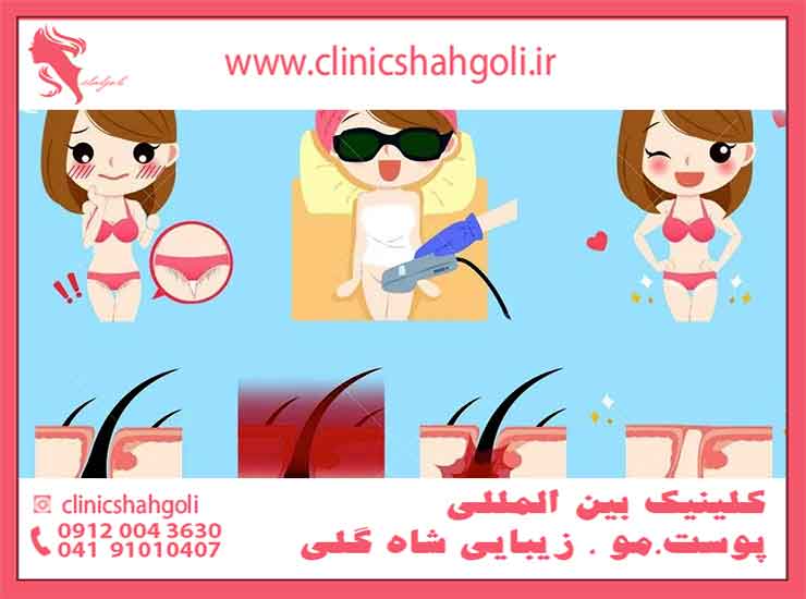 همه چیز در مورد لیزر بیکینی _ هزینه و عوارض کلینیک پوست و مو زیبایی شاه گلی همه چیز در مورد لیزر بیکینی _ هزینه و عوارض کلینیک پوست و مو زیبایی شاه گلی